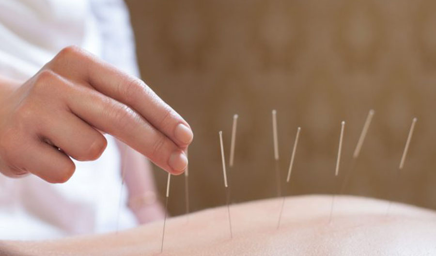 Acupuncture